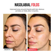 Samorazgrađujući mikroneedle flasteri