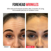 Samorazgrađujući mikroneedle flasteri