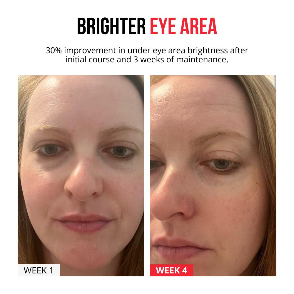 Samorazgrađujući mikroneedle flasteri