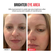 Samorazgrađujući mikroneedle flasteri