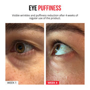 Samorazgrađujući mikroneedle flasteri